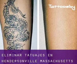 Eliminar tatuajes en Hendersonville (Massachusetts)