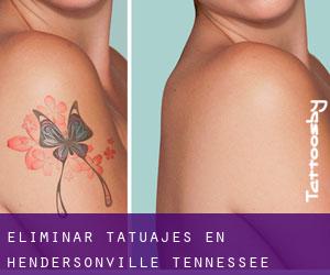 Eliminar tatuajes en Hendersonville (Tennessee)
