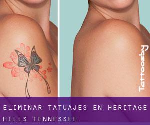 Eliminar tatuajes en Heritage Hills (Tennessee)