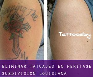 Eliminar tatuajes en Heritage Subdivision (Louisiana)