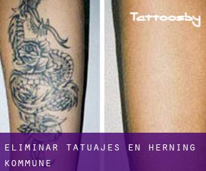 Eliminar tatuajes en Herning Kommune