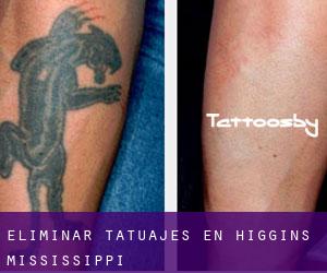 Eliminar tatuajes en Higgins (Mississippi)