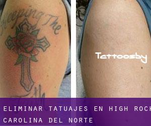 Eliminar tatuajes en High Rock (Carolina del Norte)