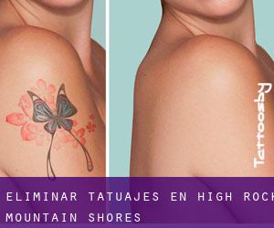 Eliminar tatuajes en High Rock Mountain Shores