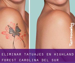 Eliminar tatuajes en Highland Forest (Carolina del Sur)