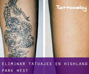 Eliminar tatuajes en Highland Park West