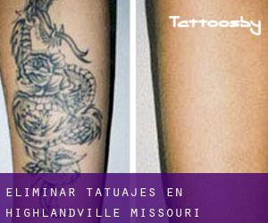 Eliminar tatuajes en Highlandville (Missouri)