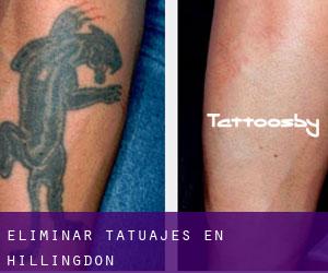 Eliminar tatuajes en Hillingdon