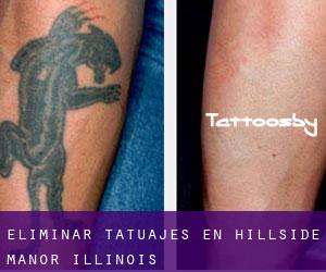Eliminar tatuajes en Hillside Manor (Illinois)