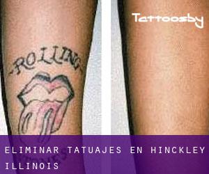 Eliminar tatuajes en Hinckley (Illinois)