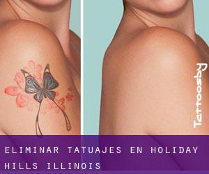 Eliminar tatuajes en Holiday Hills (Illinois)