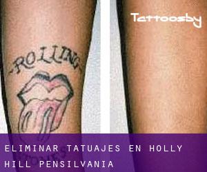 Eliminar tatuajes en Holly Hill (Pensilvania)