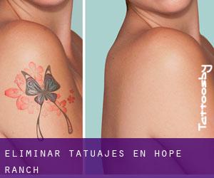 Eliminar tatuajes en Hope Ranch