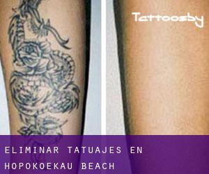 Eliminar tatuajes en Hopokoekau Beach
