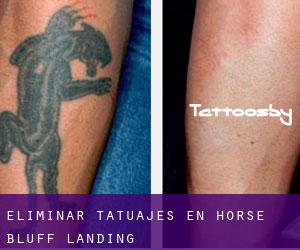 Eliminar tatuajes en Horse Bluff Landing