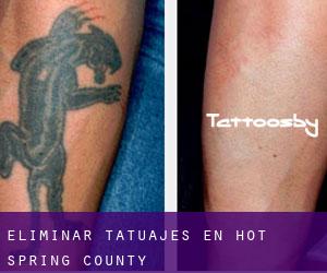 Eliminar tatuajes en Hot Spring County