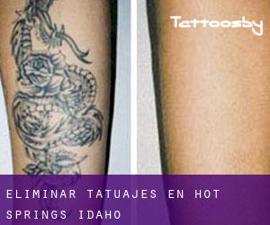 Eliminar tatuajes en Hot Springs (Idaho)