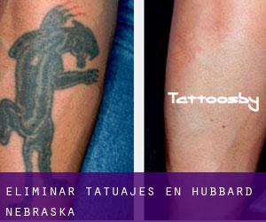 Eliminar tatuajes en Hubbard (Nebraska)