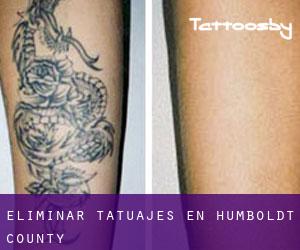 Eliminar tatuajes en Humboldt County