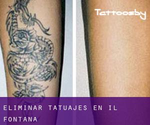 Eliminar tatuajes en Il-Fontana