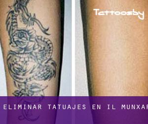 Eliminar tatuajes en Il-Munxar