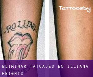Eliminar tatuajes en Illiana Heights