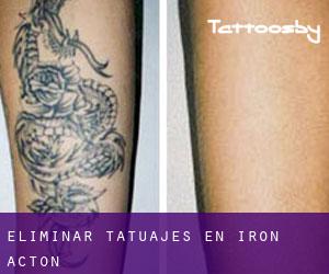 Eliminar tatuajes en Iron Acton