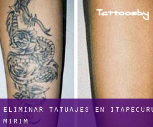 Eliminar tatuajes en Itapecuru Mirim