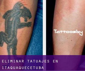 Eliminar tatuajes en Itaquaquecetuba