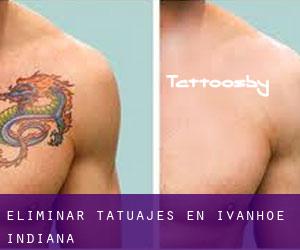 Eliminar tatuajes en Ivanhoe (Indiana)