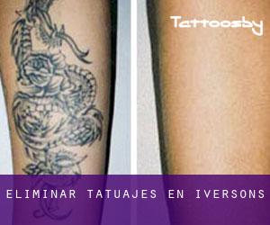 Eliminar tatuajes en Iversons