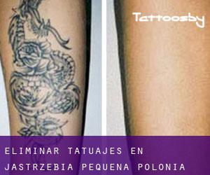 Eliminar tatuajes en Jastrzębia (Pequeña Polonia)