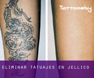 Eliminar tatuajes en Jellico