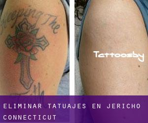 Eliminar tatuajes en Jericho (Connecticut)