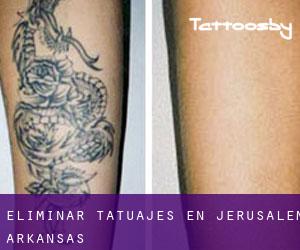 Eliminar tatuajes en Jerusalem (Arkansas)