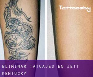Eliminar tatuajes en Jett (Kentucky)