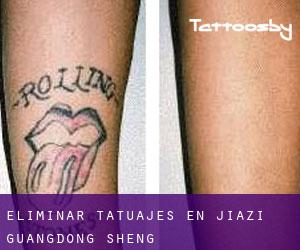 Eliminar tatuajes en Jiazi (Guangdong Sheng)