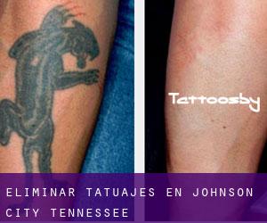 Eliminar tatuajes en Johnson City (Tennessee)