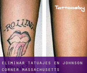 Eliminar tatuajes en Johnson Corner (Massachusetts)