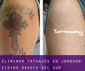 Eliminar tatuajes en Johnson Siding (Dakota del Sur)
