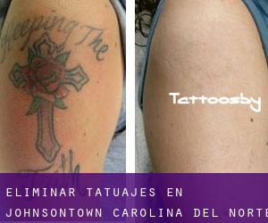 Eliminar tatuajes en Johnsontown (Carolina del Norte)