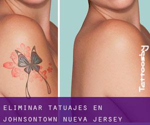 Eliminar tatuajes en Johnsontown (Nueva Jersey)
