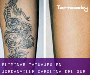Eliminar tatuajes en Jordanville (Carolina del Sur)