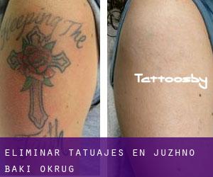 Eliminar tatuajes en Juzhno Bački Okrug