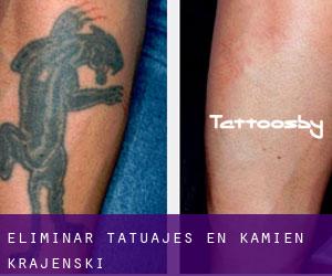 Eliminar tatuajes en Kamień Krajeński
