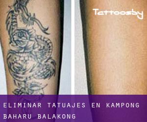 Eliminar tatuajes en Kampong Baharu Balakong