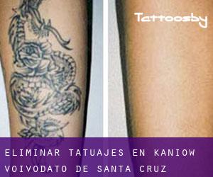 Eliminar tatuajes en Kaniów (Voivodato de Santa Cruz)