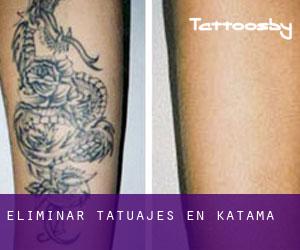 Eliminar tatuajes en Katama