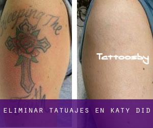 Eliminar tatuajes en Katy Did