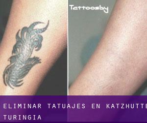 Eliminar tatuajes en Katzhütte (Turingia)